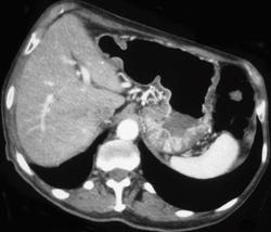 Gastric Adenocarcinoma - CTisus CT Scan