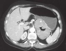 Ulcerating Gastric Leiomyosarcoma - CTisus CT Scan