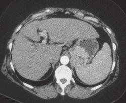 Gastric Varices (arterial/ Portal Phase Images) - CTisus CT Scan