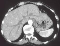 Undistended Stomach Simulates Mass - CTisus CT Scan