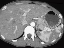 Normal Stomach - CTisus CT Scan