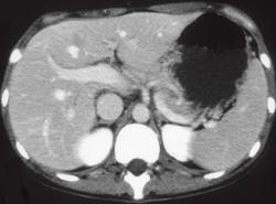 Normal Stomach - CTisus CT Scan