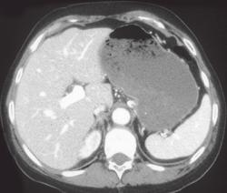 Normal Stomach - CTisus CT Scan