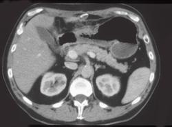 Antral Gastritis Simulates A Carcinoma - CTisus CT Scan