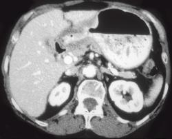 Gastric Adenocarcinoma - CTisus CT Scan