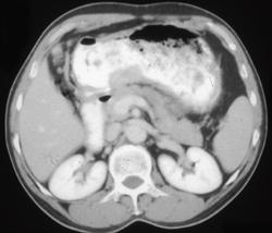 Gastric Adenocarcinoma - CTisus CT Scan