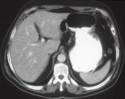 Infiltrating Gastric Carcinoma - CTisus CT Scan