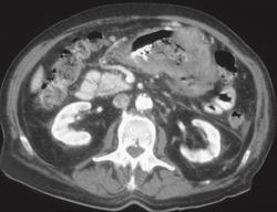 Ulcerating Gastric Carcinoma - CTisus CT Scan