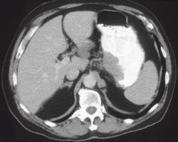 Ulcerating Gastric Adenocarcinoma With Nodes in Porta Hepatitis - CTisus CT Scan