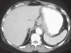 Gastric Adenocarcinoma With Nodes - CTisus CT Scan