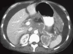 Gastric Carcinoma With Carcinomatosis and Metastases to the Ureter - CTisus CT Scan