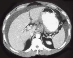 Adenocarcinoma of the Stomach With Carcinomatosis - CTisus CT Scan