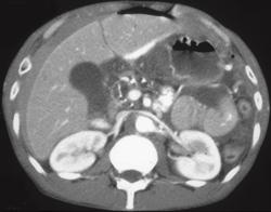 Perforation of Gastric Ulcer With Free Contrast Pneumoperitoneum in the Retroperitoneum - CTisus CT Scan