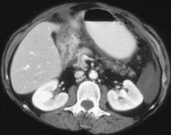 Carcinoma Infiltrates the Gastric Antrum - CTisus CT Scan