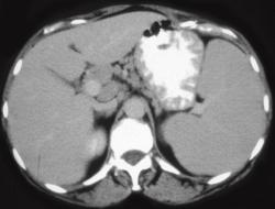 Gastric Lymphoma - CTisus CT Scan