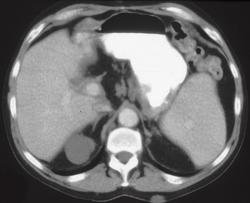 Gastric and Renal Lymphoma - CTisus CT Scan