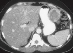 Metastasis From Ovarian Cancer Implanted on the Stomach - CTisus CT Scan