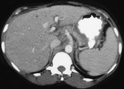 Gastric Adenocarcinoma - CTisus CT Scan