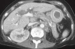 Linitis Plastica With Adenopathy - CTisus CT Scan