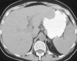 Gastric Leiomyoma - CTisus CT Scan