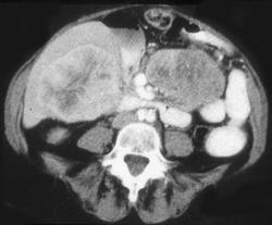 Gastric Leiomyosarcoma With Liver Metastases - CTisus CT Scan