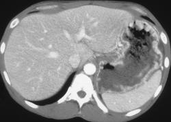 Gastritis - CTisus CT Scan