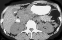 Gastric Cancer With Involvement of the Transverse Colon - CTisus CT Scan