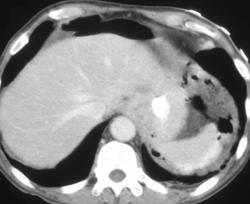 Gastric Perforation Following Failed G-tube Placement - CTisus CT Scan