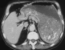 Antral Carcinoma Causes Gastric Outlet Obstruction - CTisus CT Scan