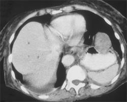 GIST Tumor - CTisus CT Scan