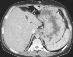 Zollinger-Ellison Syndrome With Thickened Gastric Folds - CTisus CT Scan