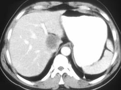 Leiomyosarcoma of the Stomach With Liver Metastases - CTisus CT Scan