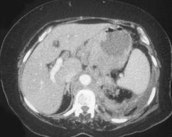 Adenocarcinoma Stomach With Extensive Nodes and Tumor Spread - CTisus CT Scan