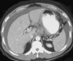 Gastric Cancer With Carcinomatosis - CTisus CT Scan