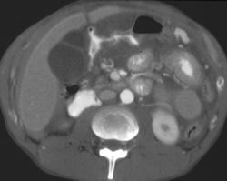 Gastric Perforation With Pneumoperitoneum and Free Contrast Near Liver Edge - CTisus CT Scan