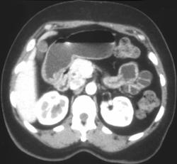 Subtle Antral Crohn's Disease - CTisus CT Scan