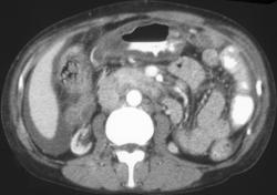 Gastritis - CTisus CT Scan