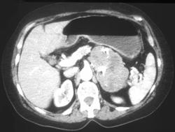 Gastric Leiomyosarcoma - CTisus CT Scan