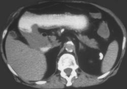 Antral Carcinoma - CTisus CT Scan