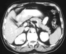 Gastric Adenocarcinoma - CTisus CT Scan