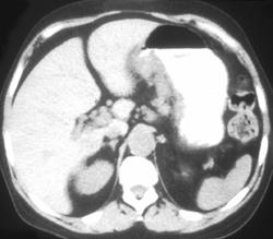 Gastric Adenocarcinoma - CTisus CT Scan