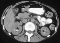 H. Pylori Infection - CTisus CT Scan