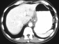 Gastric Adenocarcinoma With Liver Metastases - CTisus CT Scan