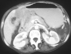 Gastric Adenocarcinoma With Local Tumor Spread and Gastric Outlet Obstruction - CTisus CT Scan