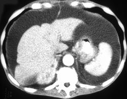 Gastric Adenocarcinoma With Drop Metastases on Rectum - CTisus CT Scan