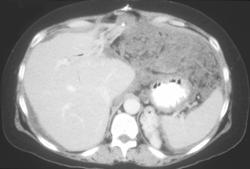 Carcinomatosis Due to Recurrent Gastric Cancer - CTisus CT Scan