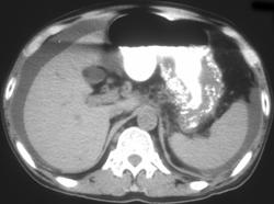 Calcified Gastric Adenocarcinoma - CTisus CT Scan