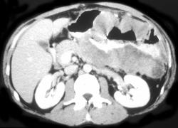 Gastric Lymphoma - CTisus CT Scan