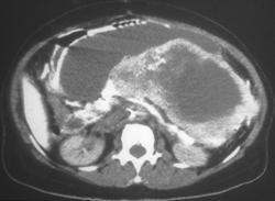 Gastric Leiomyosarcoma - CTisus CT Scan