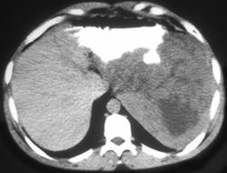 Gastric Leiomyosarcoma - CTisus CT Scan